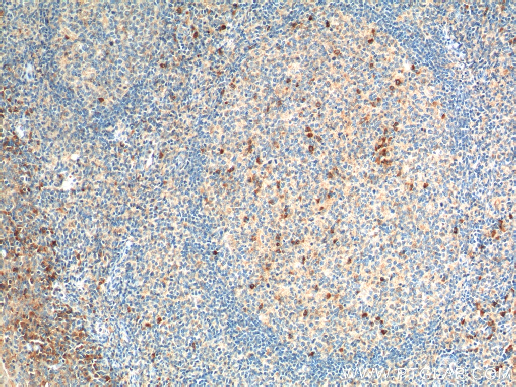 IHC staining of human tonsillitis using 22351-1-AP