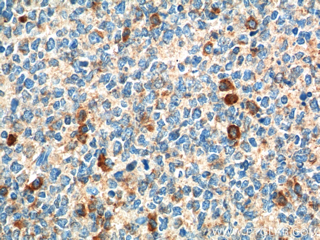 Immunohistochemistry (IHC) staining of human tonsillitis tissue using CCR3 Polyclonal antibody (22351-1-AP)