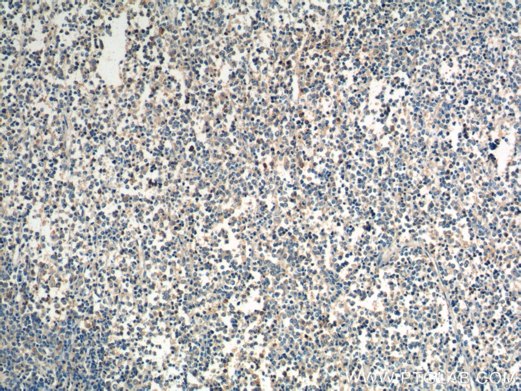 Immunohistochemistry (IHC) staining of human lymphoma tissue using CCR3 Polyclonal antibody (22351-1-AP)