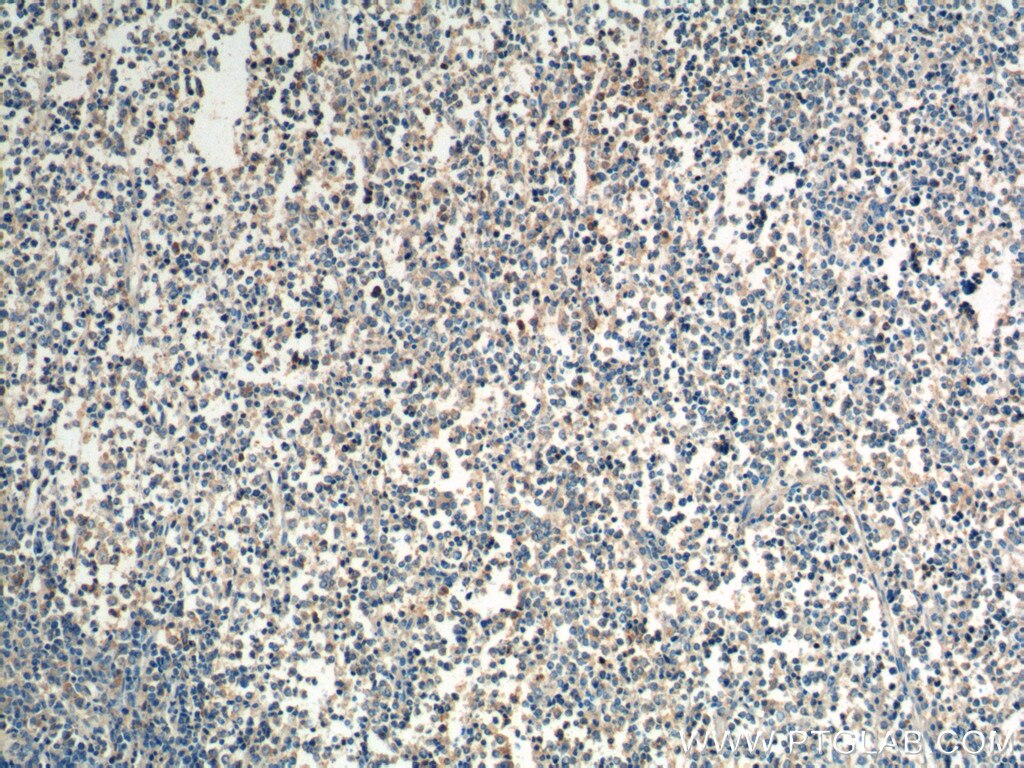 Immunohistochemistry (IHC) staining of human lymphoma tissue using CCR3 Polyclonal antibody (22351-1-AP)