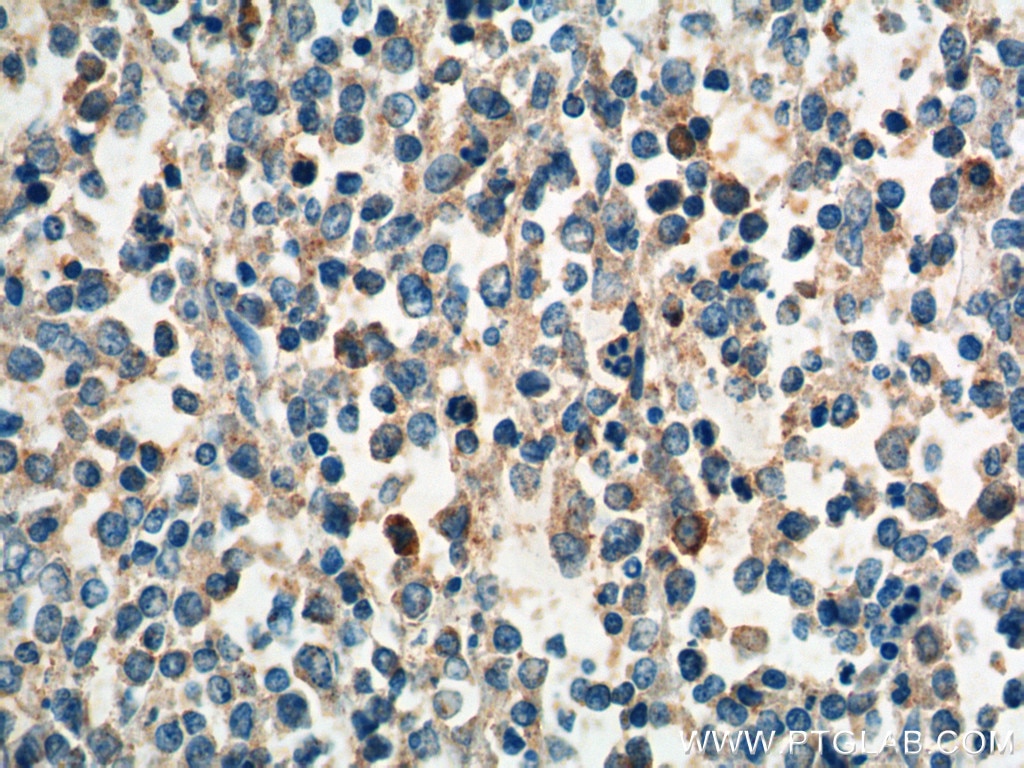 Immunohistochemistry (IHC) staining of human lymphoma tissue using CCR3 Polyclonal antibody (22351-1-AP)