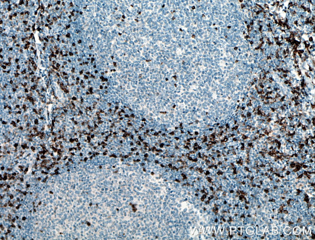 Immunohistochemistry (IHC) staining of human tonsillitis tissue using CCR5 Polyclonal antibody (17476-1-AP)