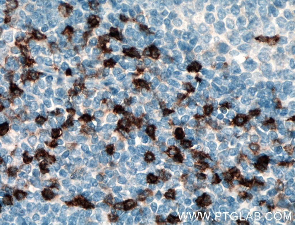 Immunohistochemistry (IHC) staining of human tonsillitis tissue using CCR5 Polyclonal antibody (17476-1-AP)