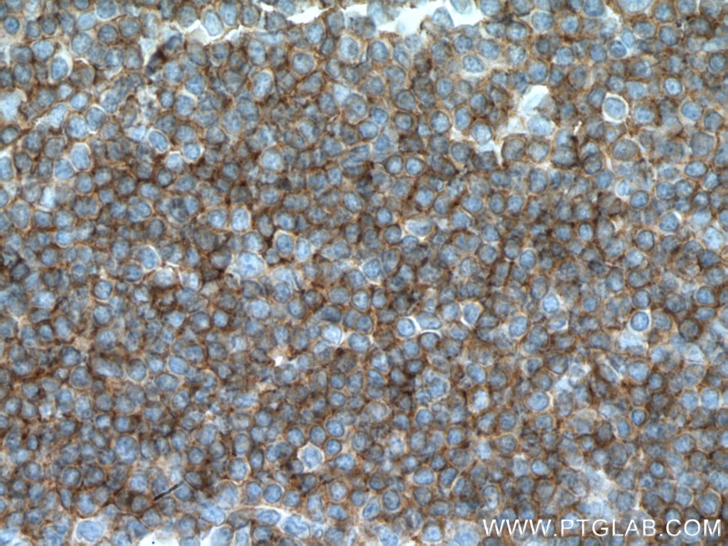 Immunohistochemistry (IHC) staining of human tonsillitis tissue using CCR6 Monoclonal antibody (66801-1-Ig)