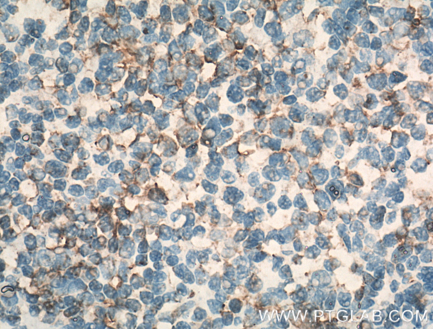 Immunohistochemistry (IHC) staining of human tonsillitis tissue using CCR7 Polyclonal antibody (25898-1-AP)