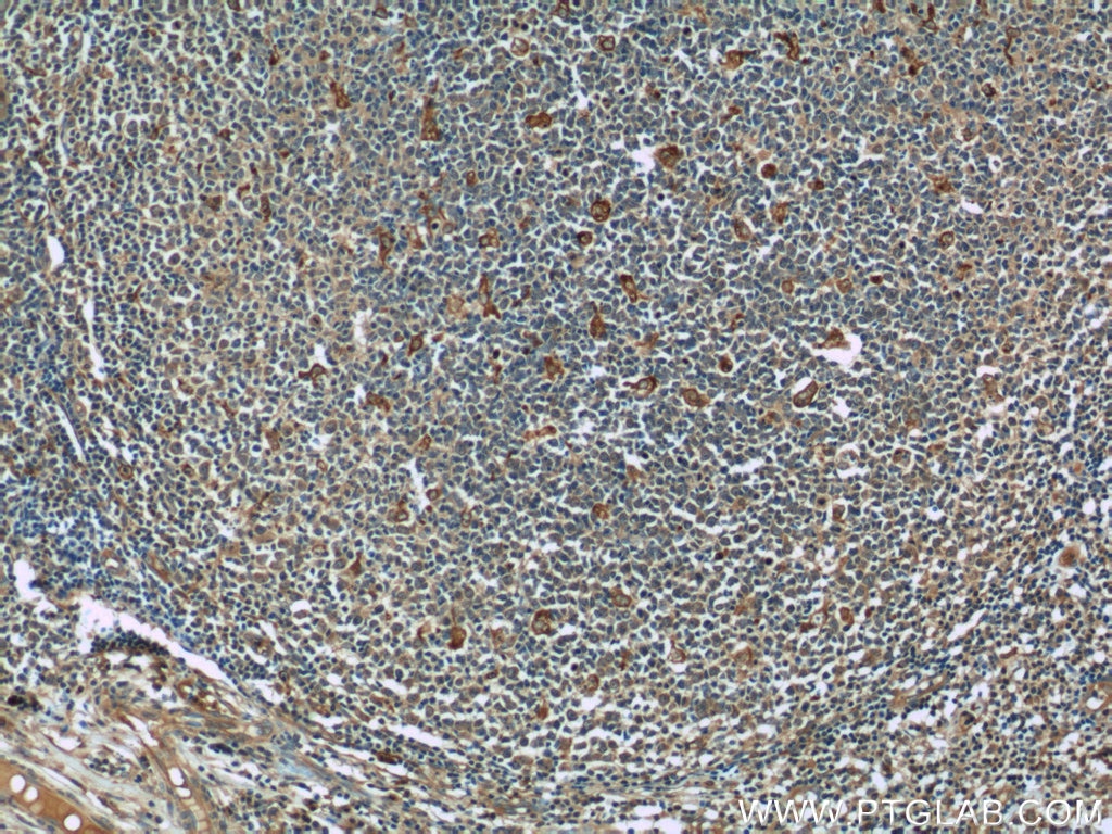 Immunohistochemistry (IHC) staining of human tonsillitis tissue using CCR7 Polyclonal antibody (55425-1-AP)