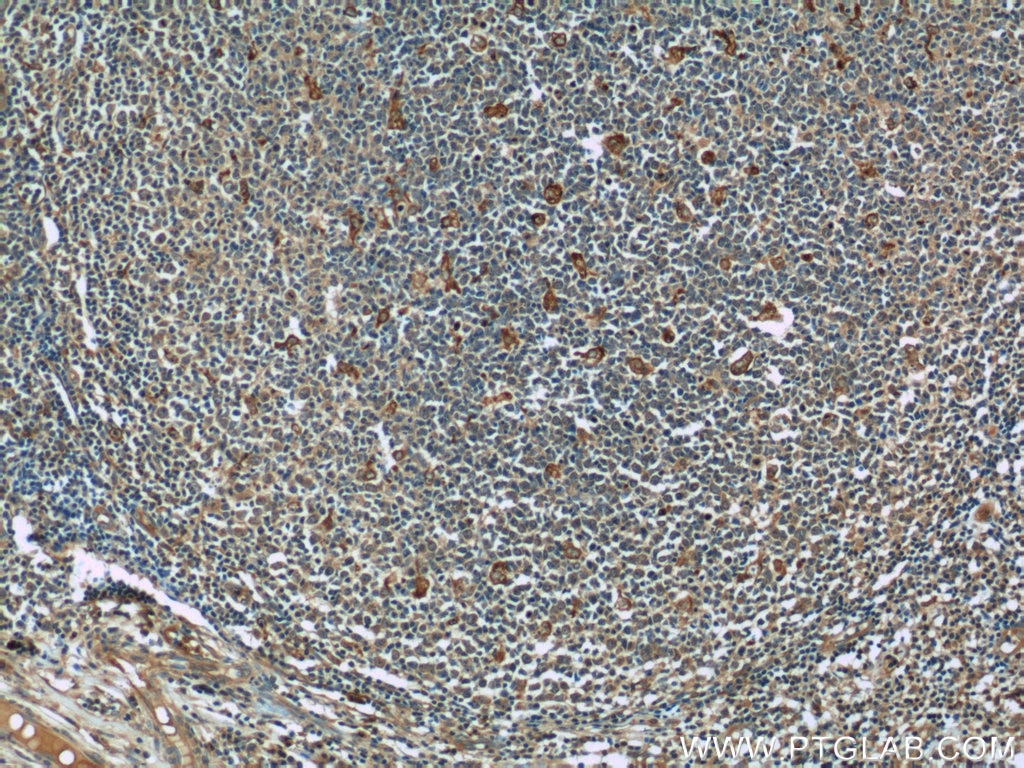 IHC staining of human tonsillitis using 55425-1-AP