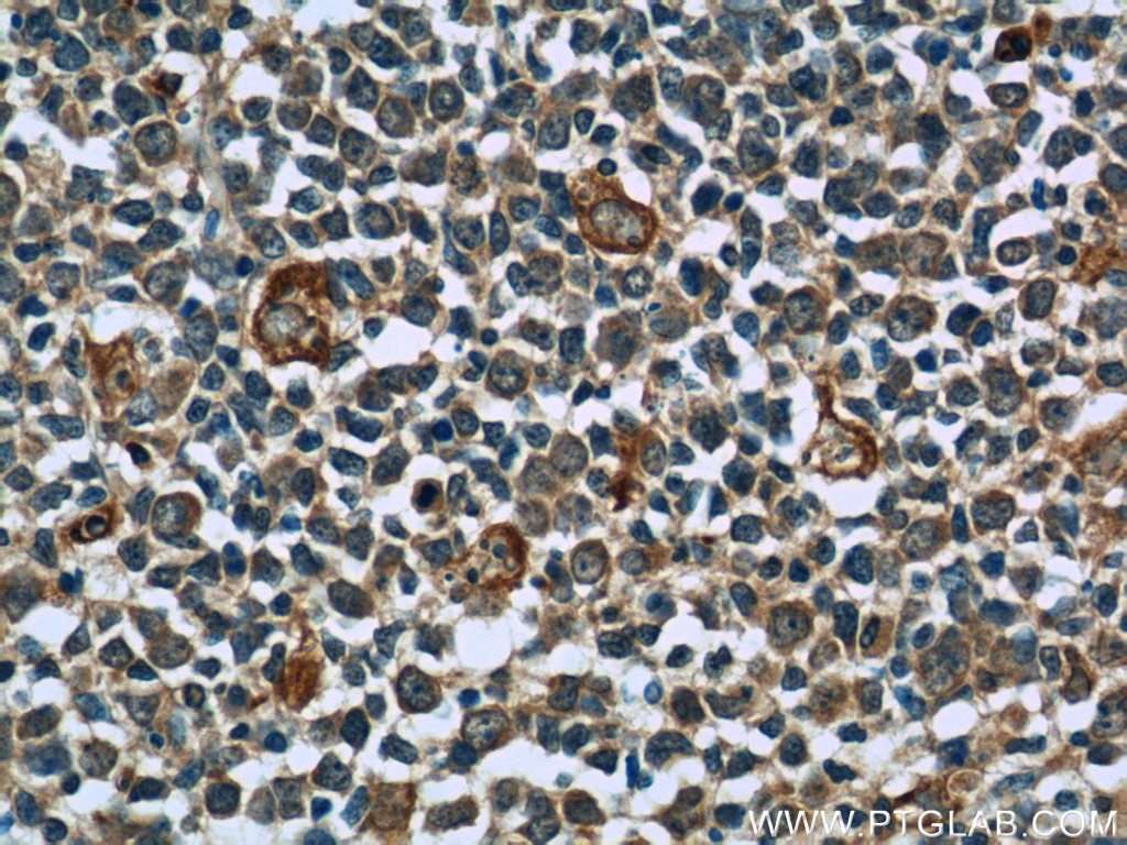 Immunohistochemistry (IHC) staining of human tonsillitis tissue using CCR7 Polyclonal antibody (55425-1-AP)