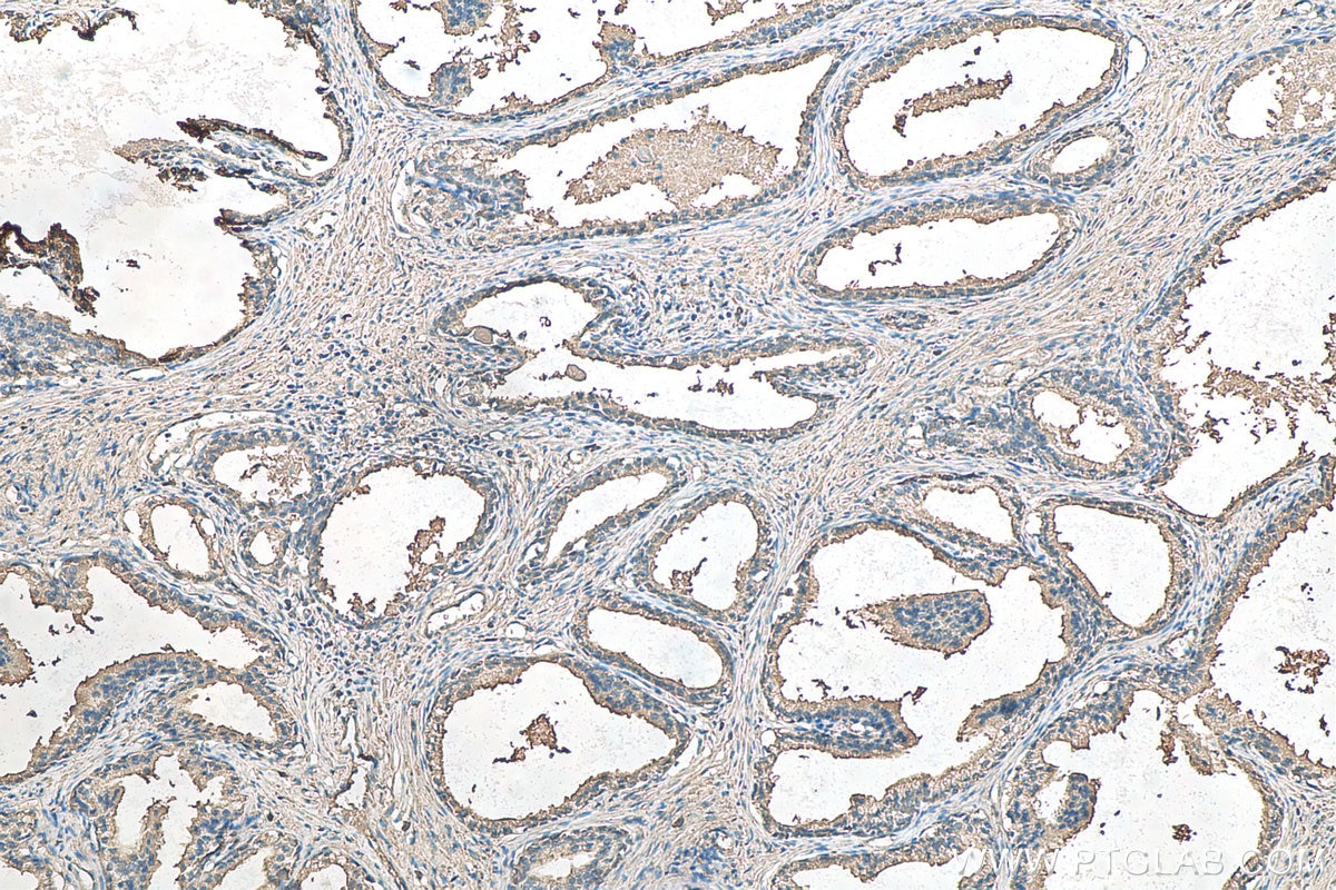 Immunohistochemistry (IHC) staining of human prostate cancer tissue using CCS Polyclonal antibody (22802-1-AP)