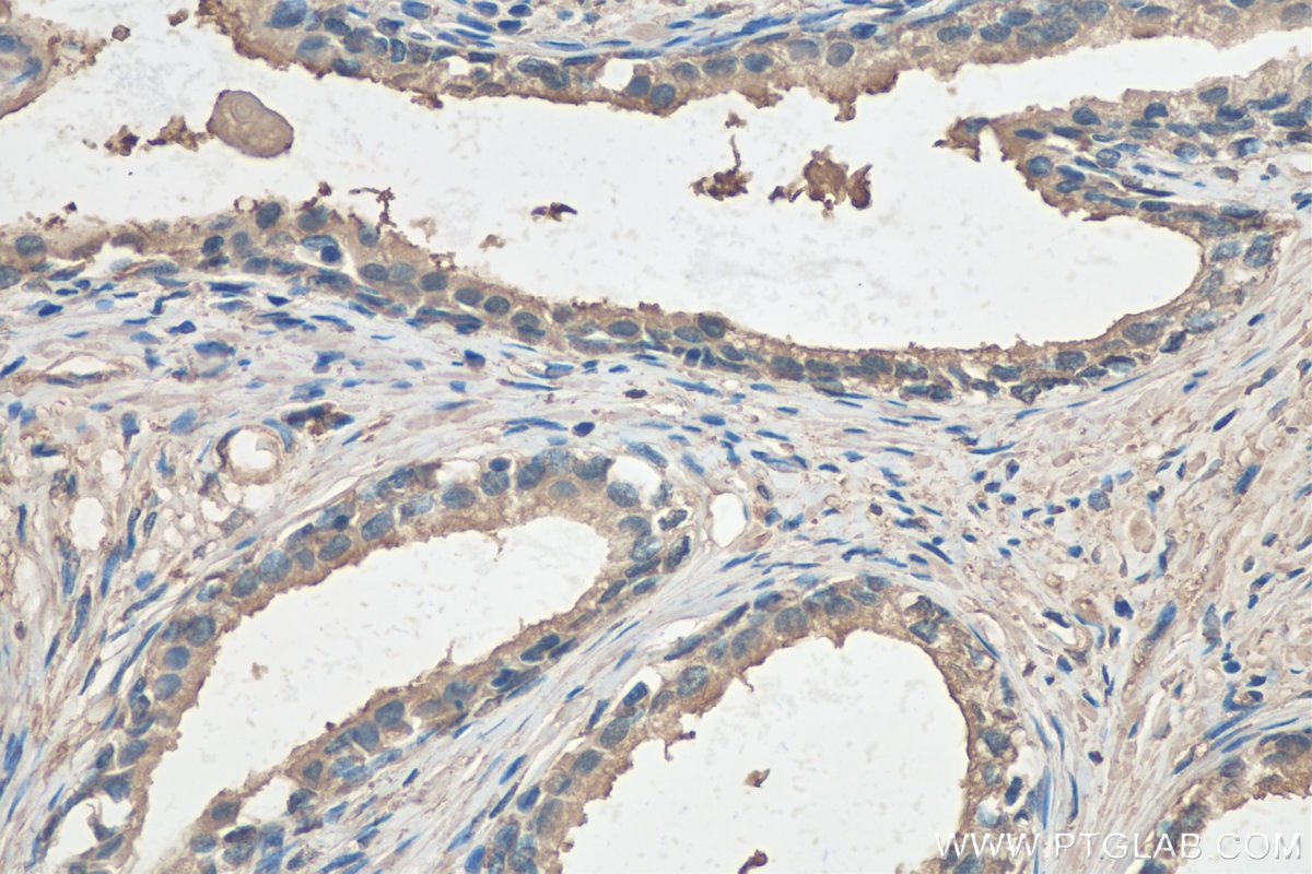 Immunohistochemistry (IHC) staining of human prostate cancer tissue using CCS Polyclonal antibody (22802-1-AP)