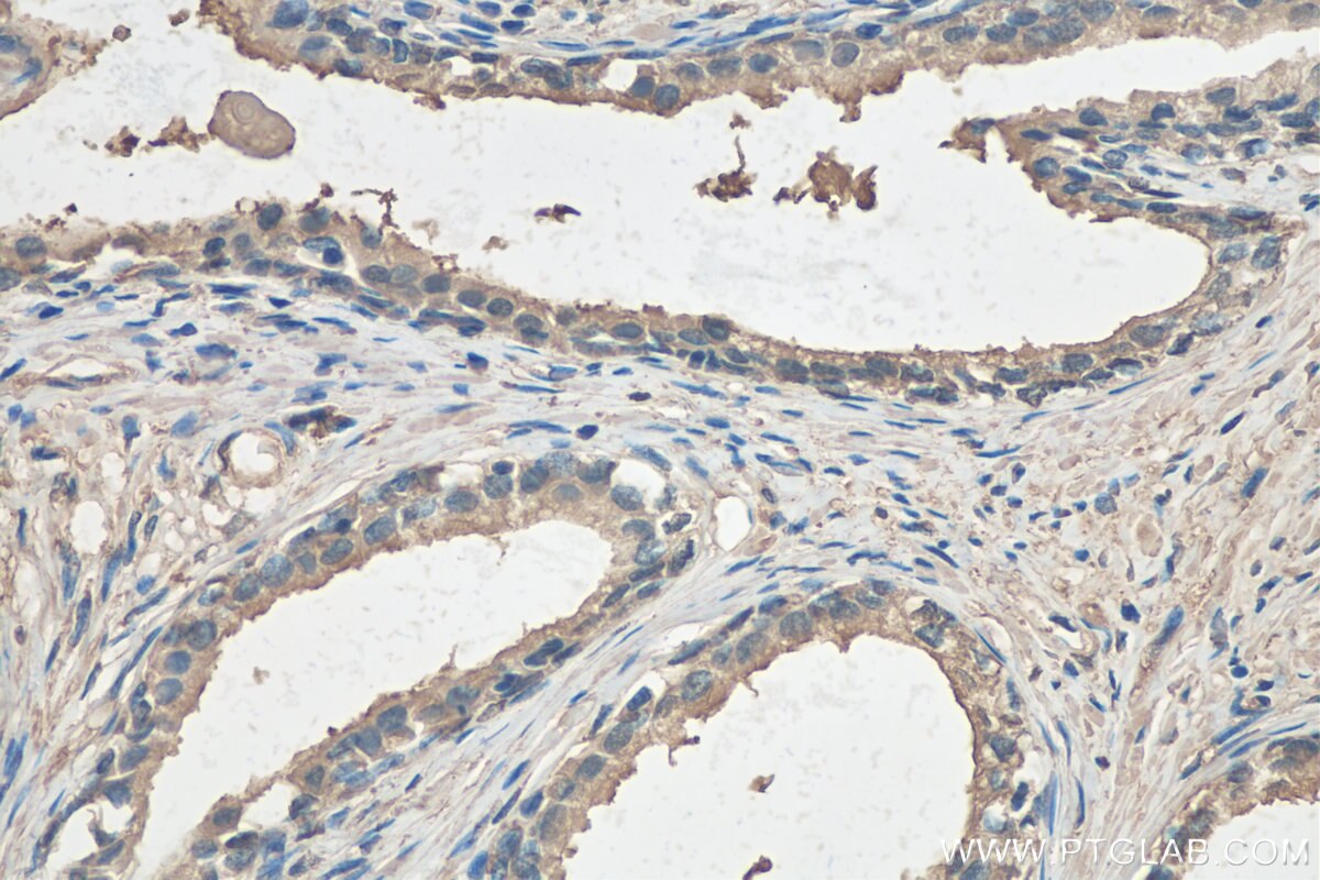 IHC staining of human prostate cancer using 22802-1-AP