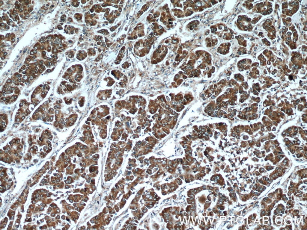 IHC staining of human liver cancer using 10571-1-AP