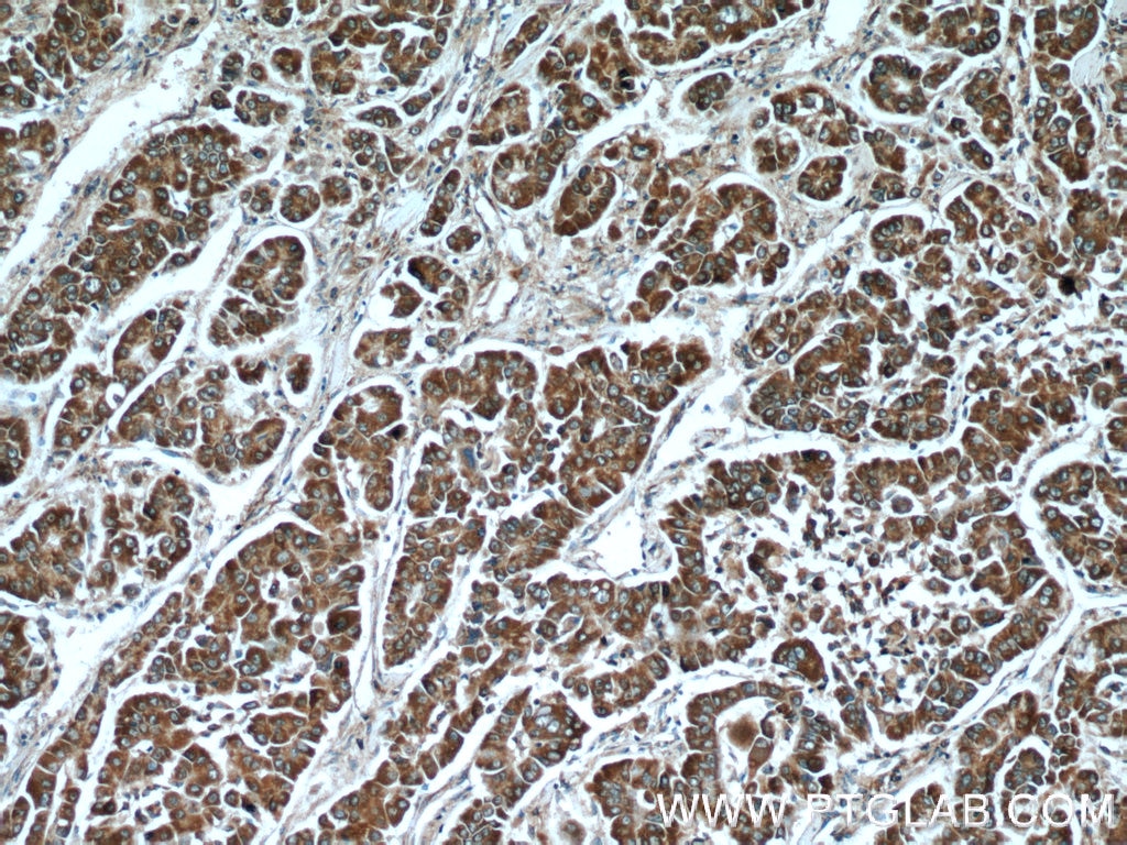 Immunohistochemistry (IHC) staining of human liver cancer tissue using CCT3 Polyclonal antibody (10571-1-AP)