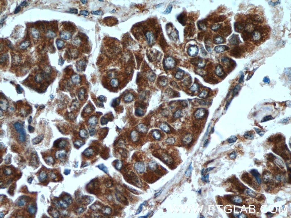 Immunohistochemistry (IHC) staining of human liver cancer tissue using CCT3 Polyclonal antibody (10571-1-AP)
