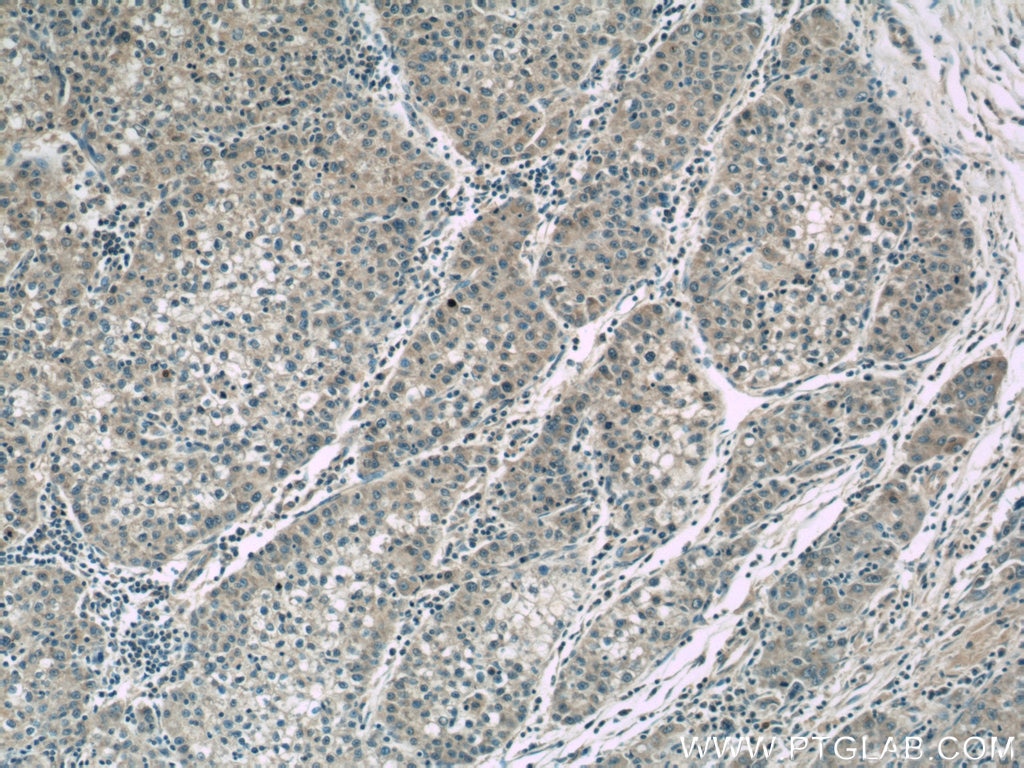IHC staining of human liver cancer using 60264-1-Ig
