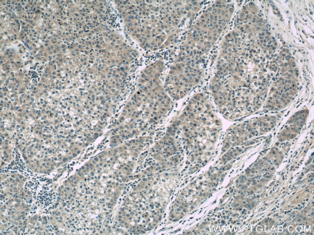 Immunohistochemistry (IHC) staining of human liver cancer tissue using CCT3 Monoclonal antibody (60264-1-Ig)