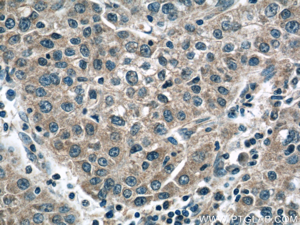 Immunohistochemistry (IHC) staining of human liver cancer tissue using CCT3 Monoclonal antibody (60264-1-Ig)