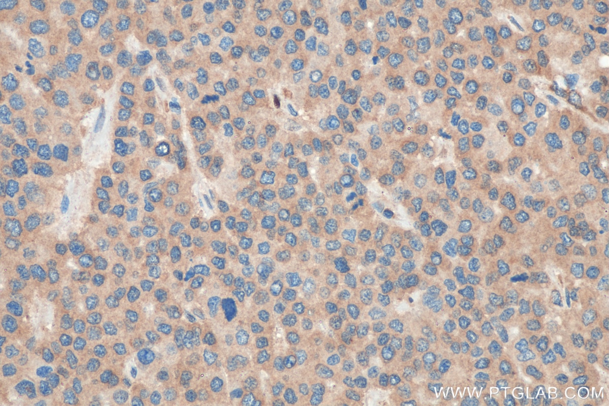 Immunohistochemistry (IHC) staining of human liver cancer tissue using CCT4 Polyclonal antibody (21524-1-AP)