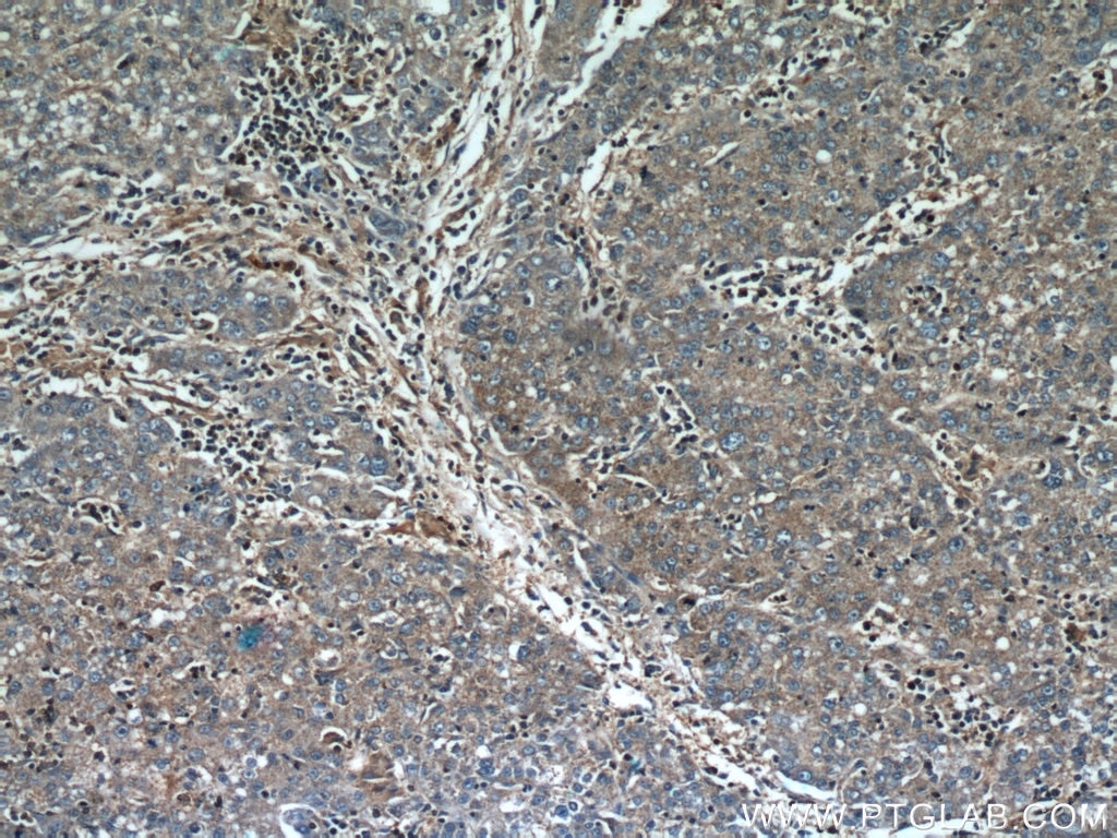 Immunohistochemistry (IHC) staining of human liver cancer tissue using CCT4 Polyclonal antibody (21524-1-AP)