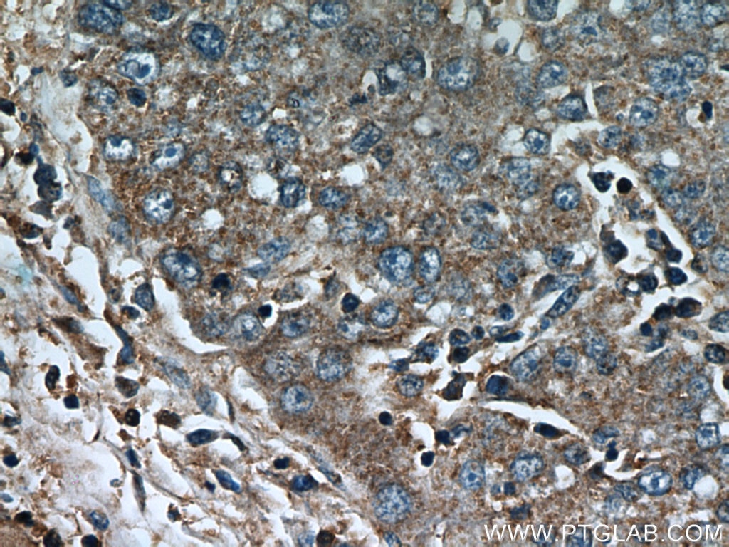 Immunohistochemistry (IHC) staining of human liver cancer tissue using CCT4 Polyclonal antibody (21524-1-AP)