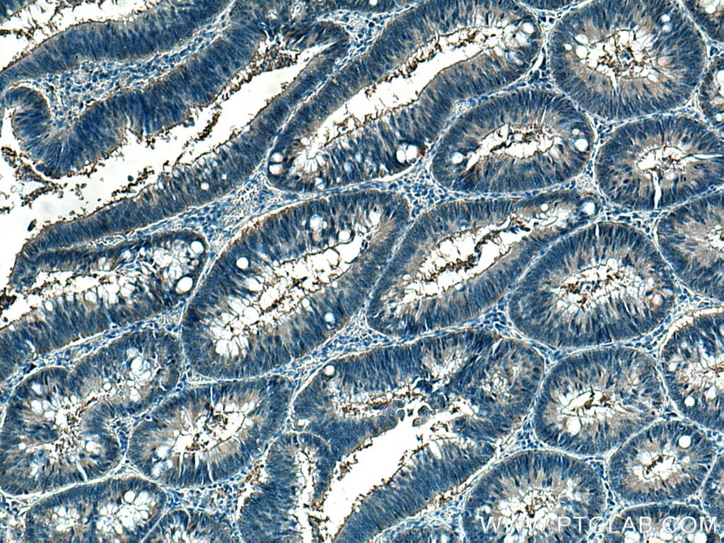 Immunohistochemistry (IHC) staining of human colon cancer tissue using CCT5 Polyclonal antibody (11603-1-AP)