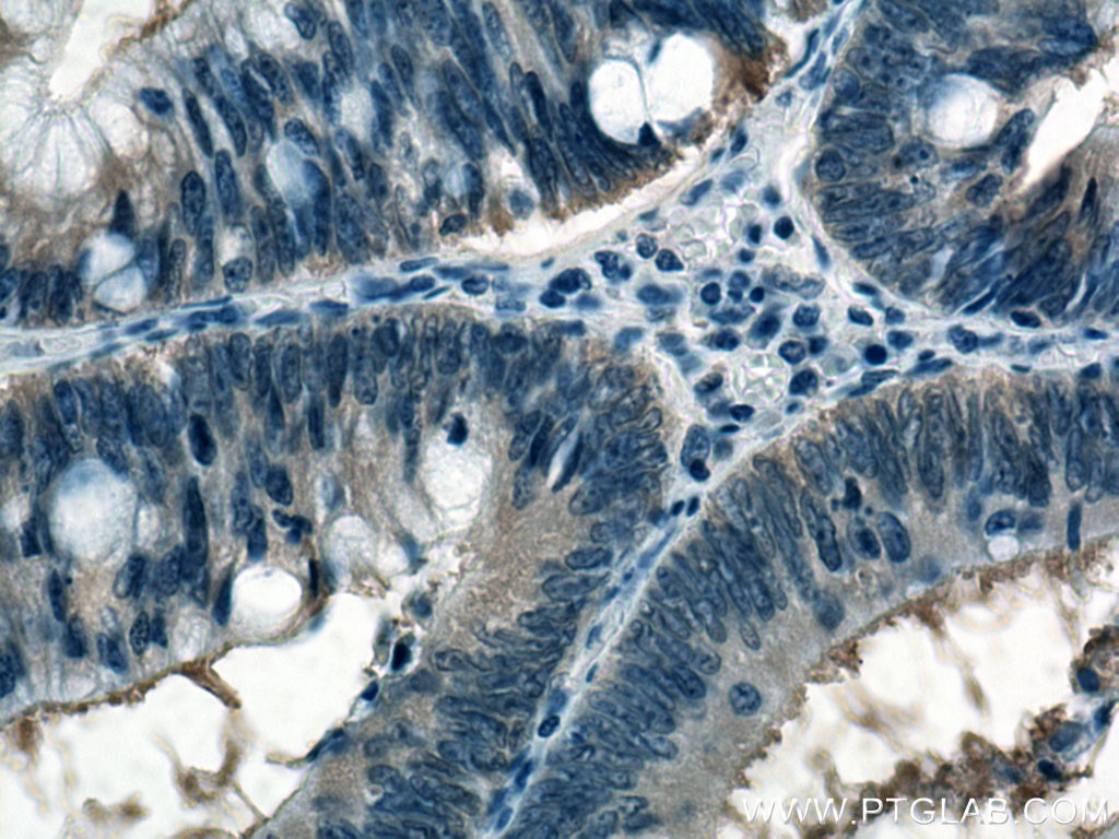 Immunohistochemistry (IHC) staining of human colon cancer tissue using CCT5 Polyclonal antibody (11603-1-AP)