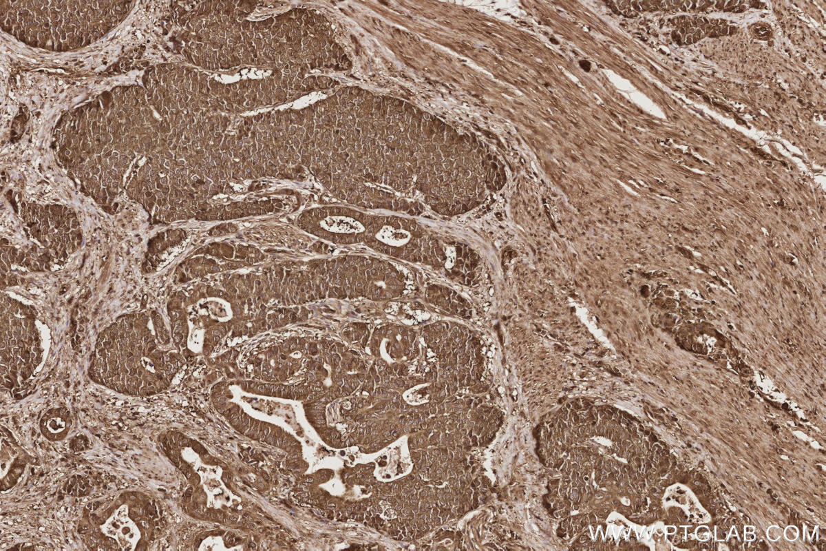 Immunohistochemistry (IHC) staining of human stomach cancer tissue using TCP1 eta Monoclonal antibody (67540-1-Ig)