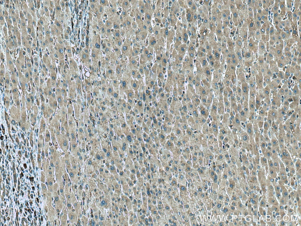 Immunohistochemistry (IHC) staining of human liver cancer tissue using CCT8 Monoclonal antibody (67539-1-Ig)