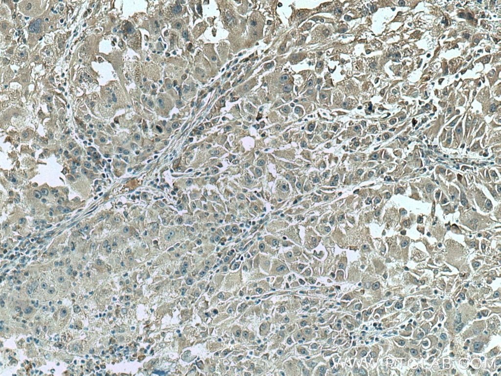 Immunohistochemistry (IHC) staining of human liver cancer tissue using CCT8 Monoclonal antibody (67539-1-Ig)
