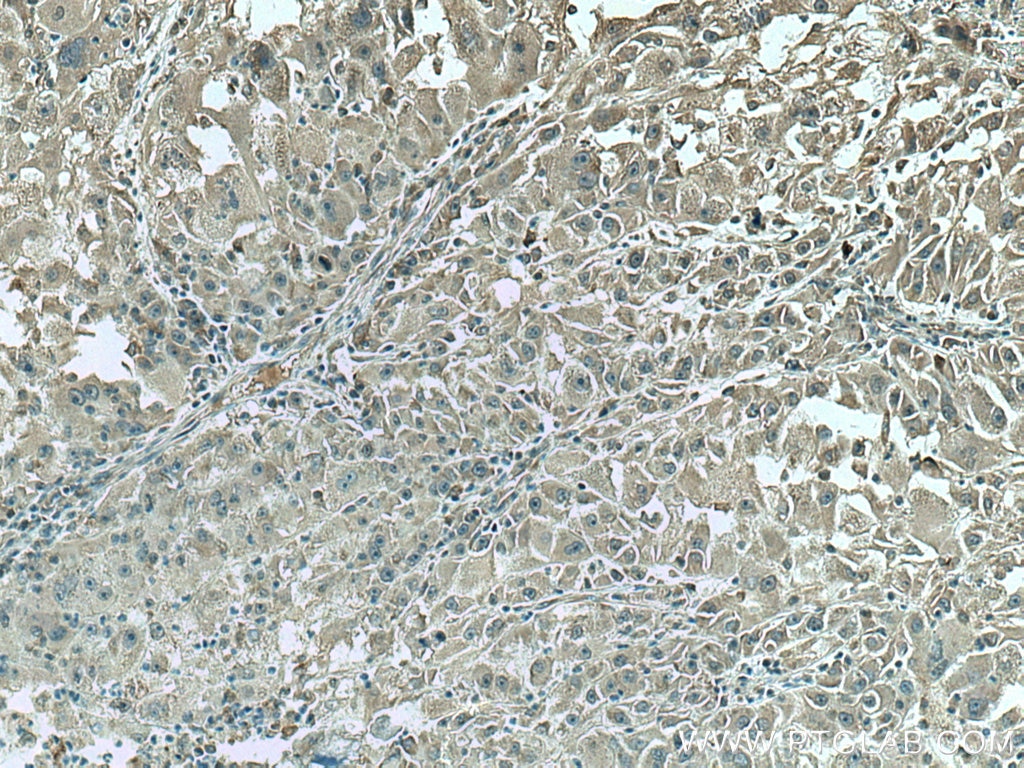 IHC staining of human liver cancer using 67539-1-Ig