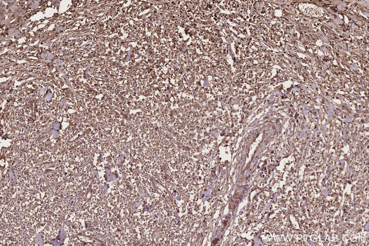 IHC staining of human colon cancer using 67539-1-Ig Immunohistochemistry (IHC) staining of human colon cancer tissue using CCT8 Monoclonal antibody (67539-1-Ig)