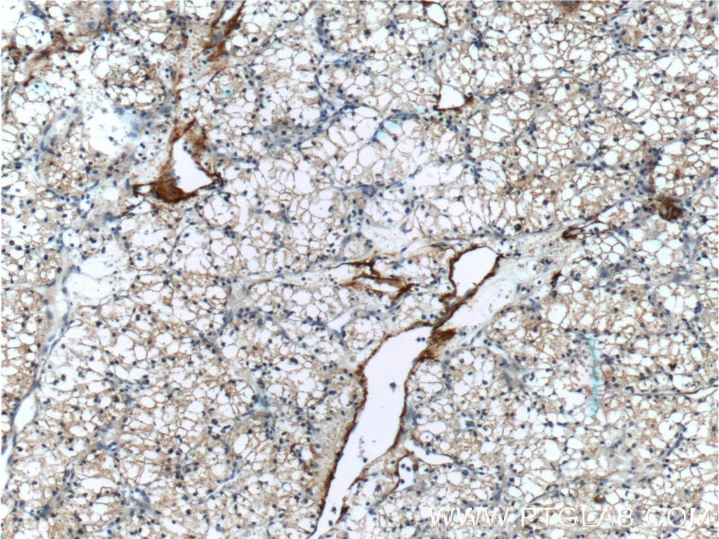 Immunohistochemistry (IHC) staining of human renal cell carcinoma tissue using MME,CD10 Polyclonal antibody (23782-1-AP)