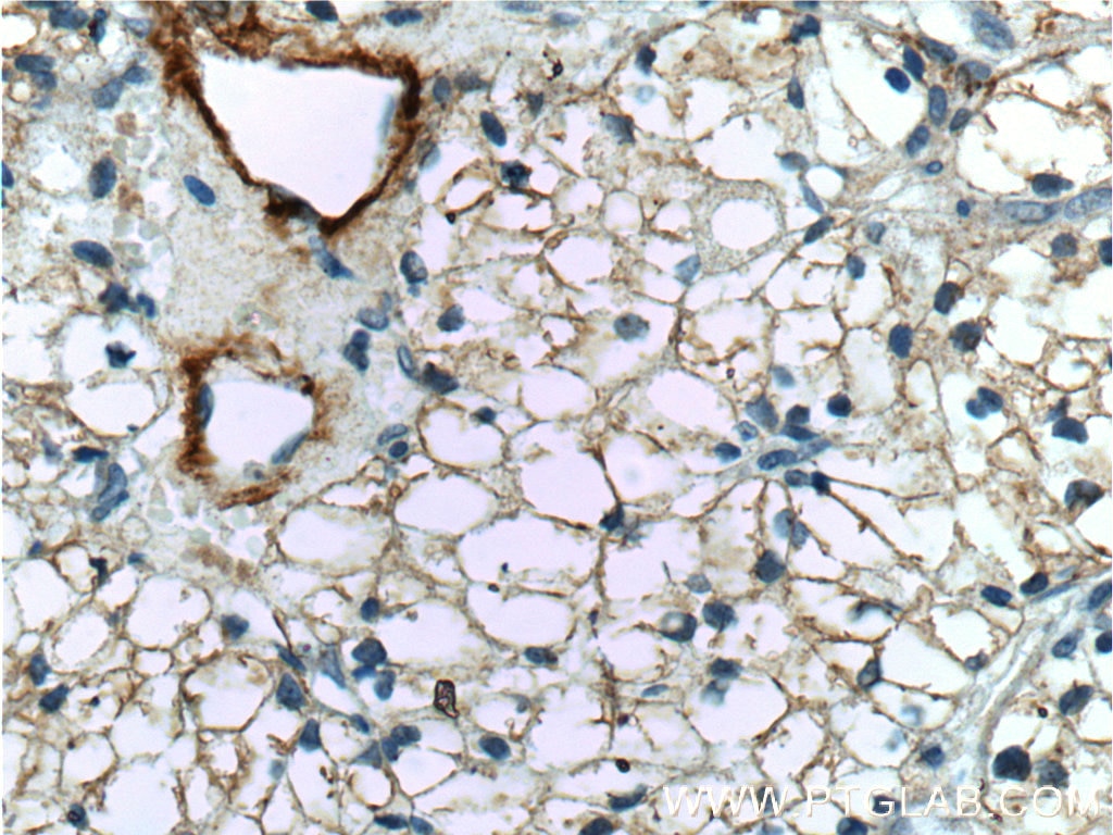 Immunohistochemistry (IHC) staining of human renal cell carcinoma tissue using MME,CD10 Polyclonal antibody (23782-1-AP)