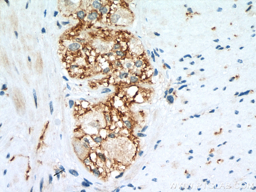 Immunohistochemistry (IHC) staining of human colon tissue using CD100 Polyclonal antibody (27516-1-AP)