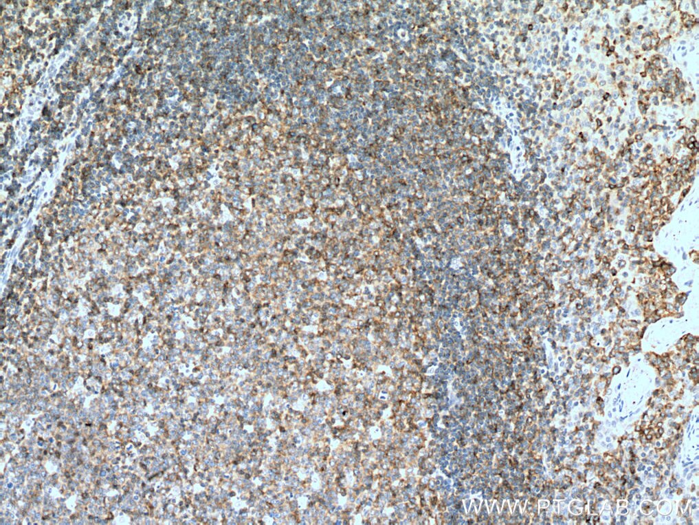 Immunohistochemistry (IHC) staining of human tonsillitis tissue using CD100 Polyclonal antibody (27516-1-AP)