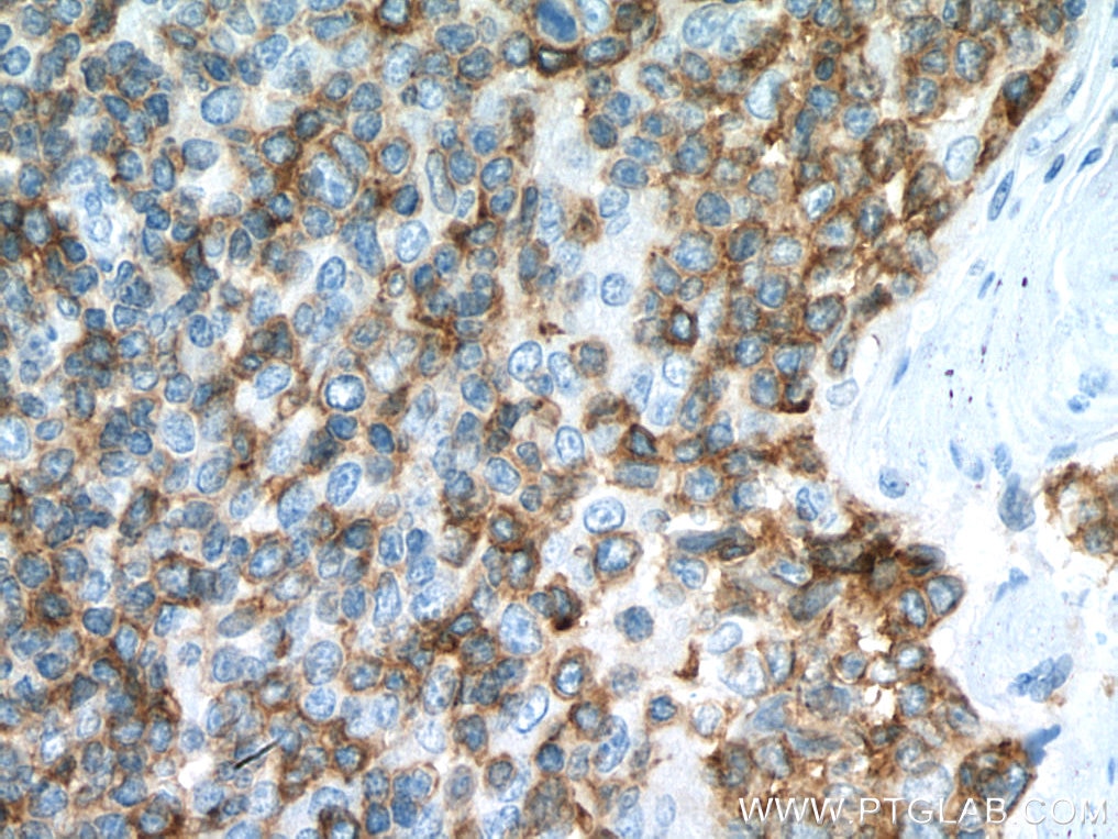Immunohistochemistry (IHC) staining of human tonsillitis tissue using CD100 Polyclonal antibody (27516-1-AP)