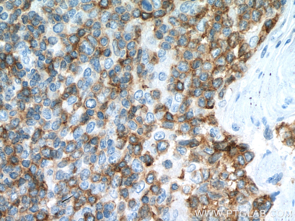 IHC staining of human tonsillitis using 27516-1-AP