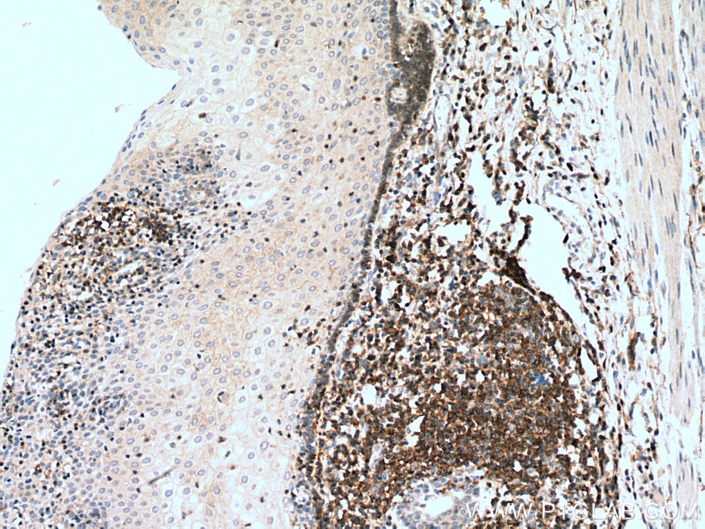 Immunohistochemistry (IHC) staining of human oesophagus cancer tissue using CD100 Polyclonal antibody (27516-1-AP)