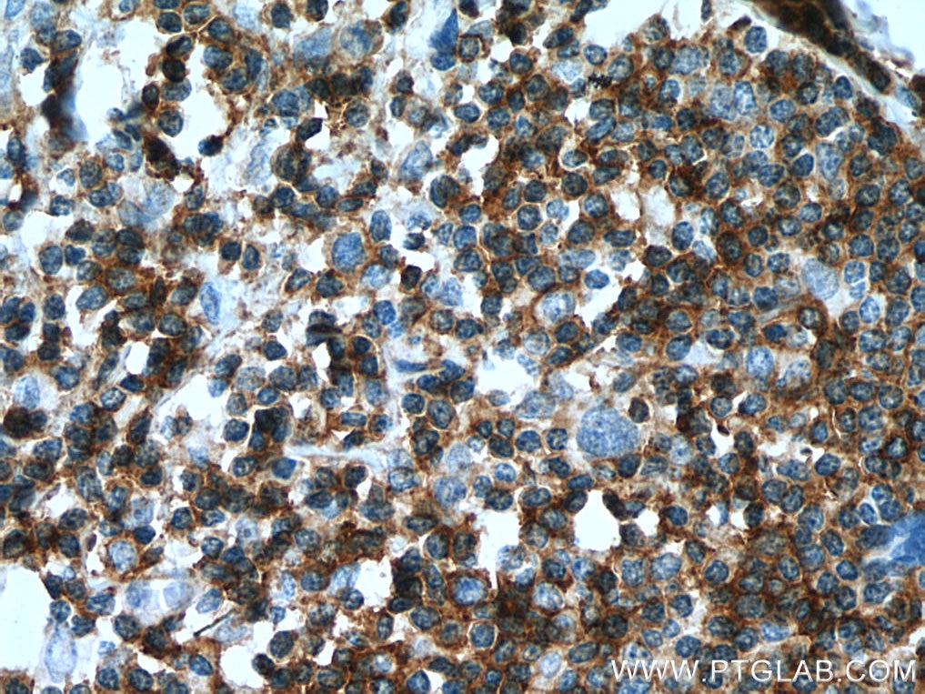 Immunohistochemistry (IHC) staining of human oesophagus cancer tissue using CD100 Polyclonal antibody (27516-1-AP)
