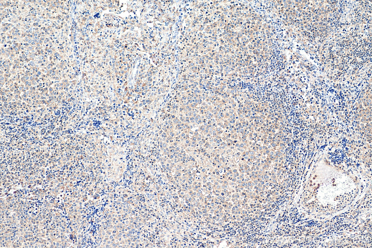 Immunohistochemistry (IHC) staining of human lymphoma tissue using CD100 Monoclonal antibody (66582-1-Ig)
