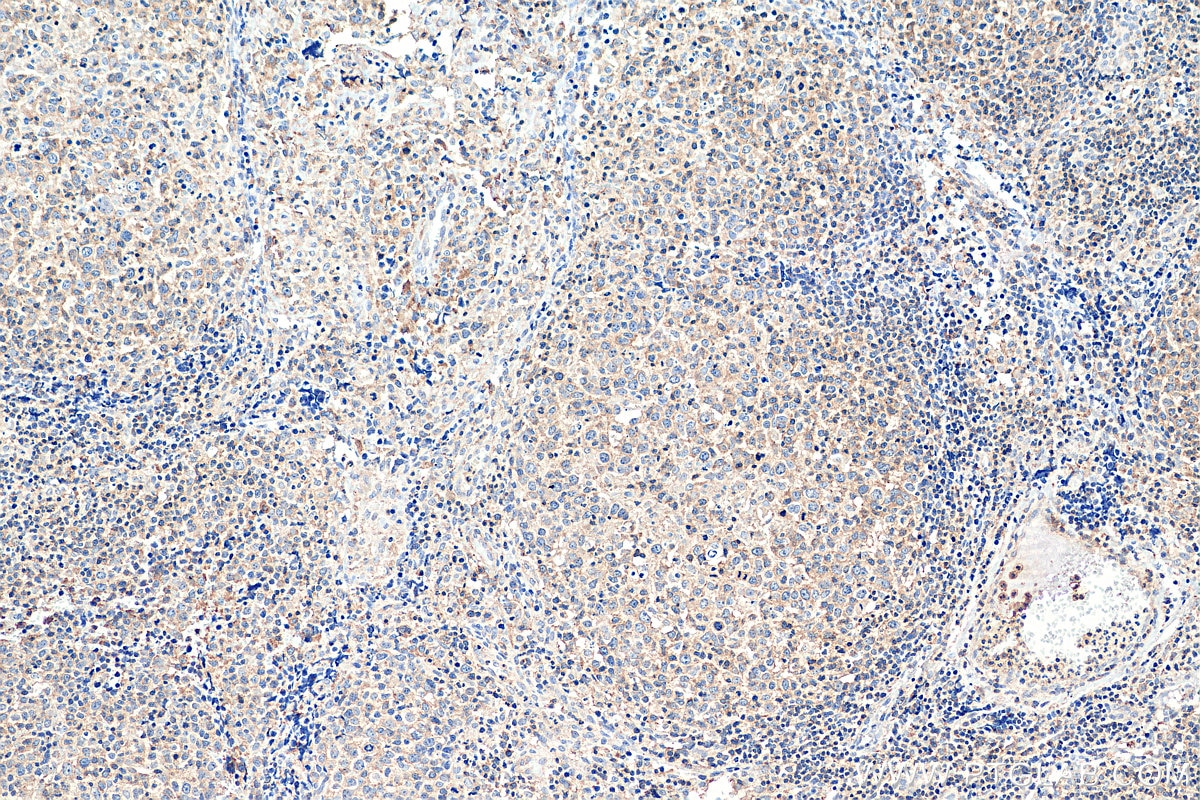 IHC staining of human lymphoma using 66582-1-Ig