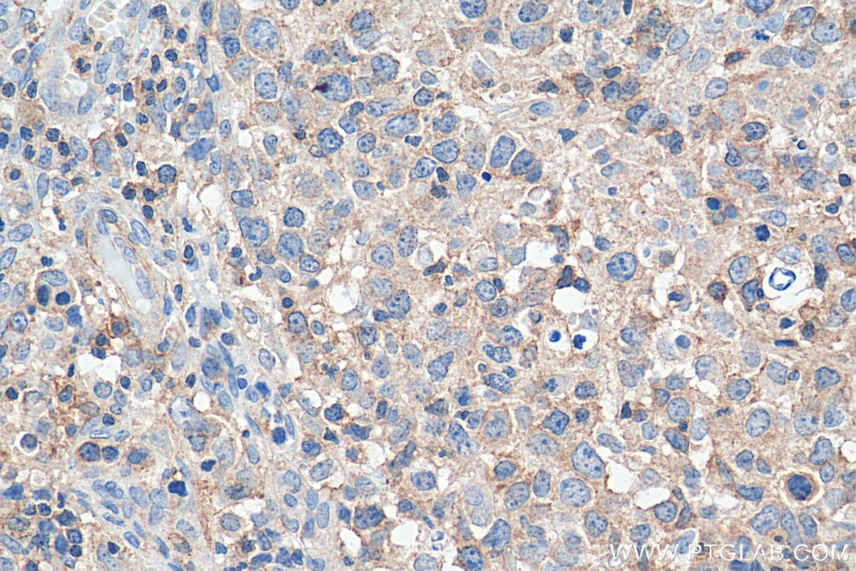 Immunohistochemistry (IHC) staining of human lymphoma tissue using CD100 Monoclonal antibody (66582-1-Ig)