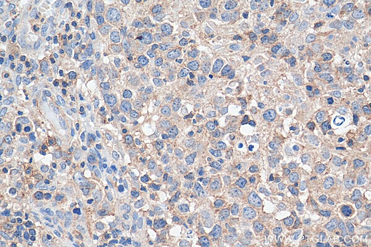 IHC staining of human lymphoma using 66582-1-Ig