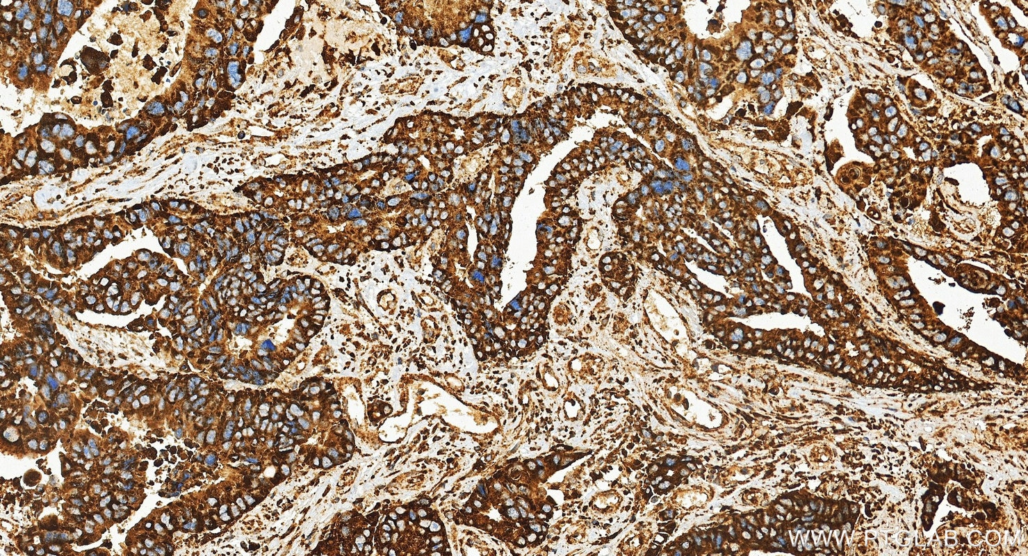 Immunohistochemistry (IHC) staining of human colon cancer tissue using CD107a / LAMP1 Polyclonal antibody (21997-1-AP)