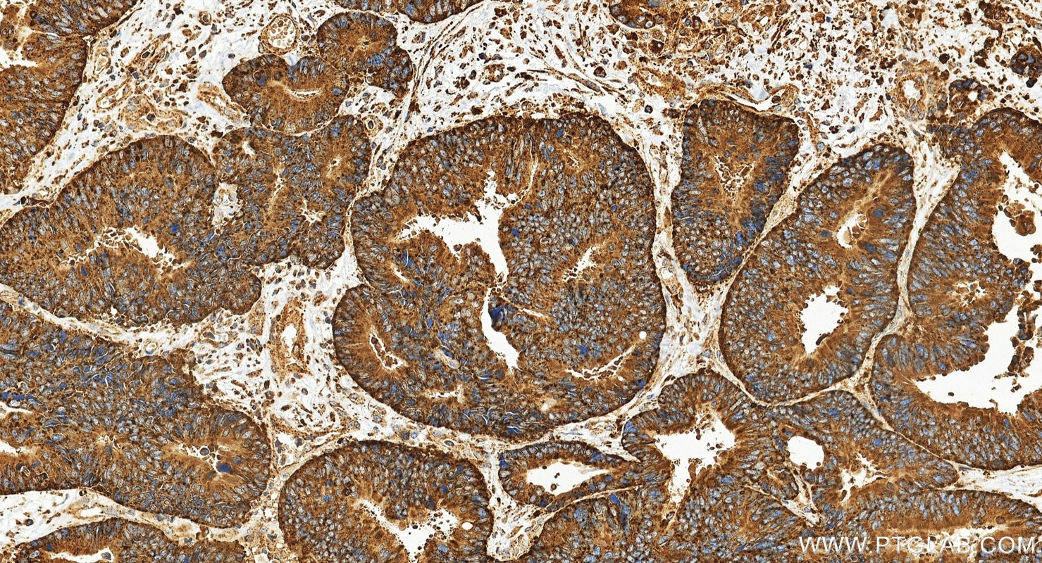 Immunohistochemistry (IHC) staining of human colon cancer tissue using CD107a / LAMP1 Polyclonal antibody (21997-1-AP)