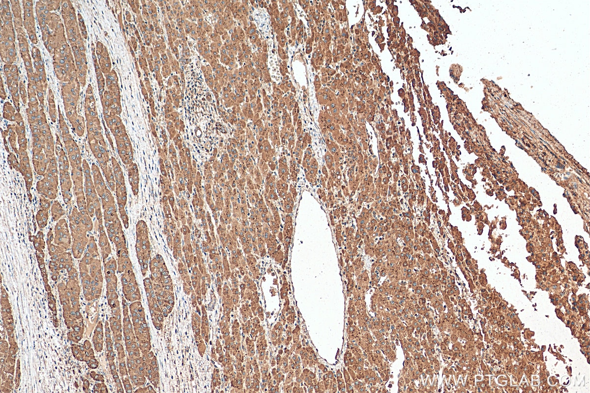 Immunohistochemistry (IHC) staining of human liver cancer tissue using CD107a / LAMP1 Polyclonal antibody (21997-1-AP)