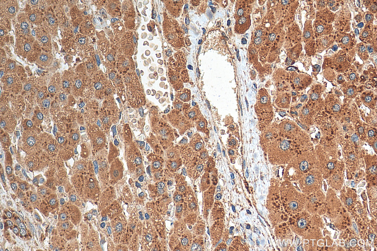 Immunohistochemistry (IHC) staining of human liver cancer tissue using CD107a / LAMP1 Polyclonal antibody (21997-1-AP)