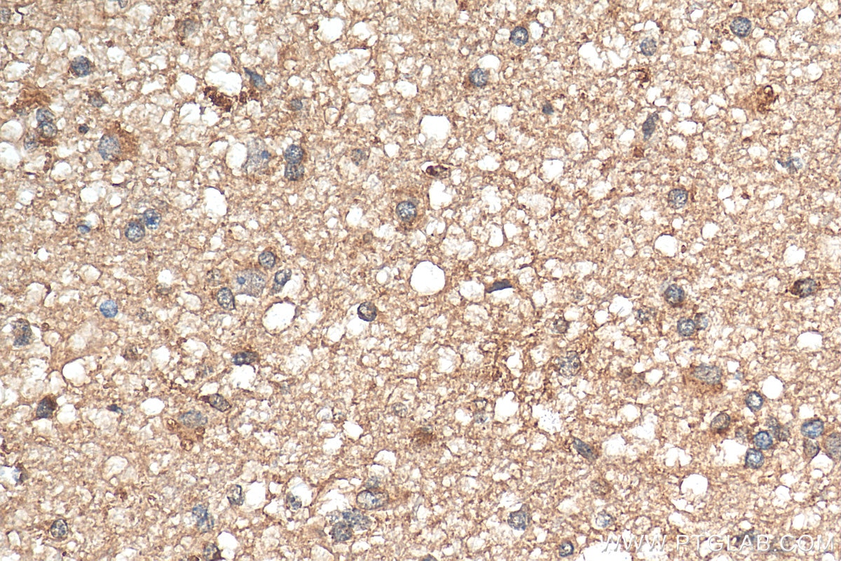 Immunohistochemistry (IHC) staining of human gliomas tissue using CD107a / LAMP1 Polyclonal antibody (21997-1-AP)