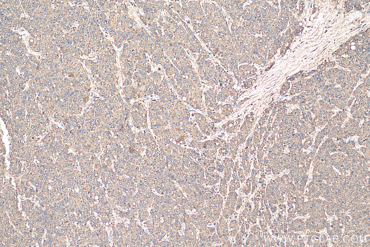Immunohistochemistry (IHC) staining of human liver cancer tissue using CD107a / LAMP1 Polyclonal antibody (21997-1-AP)