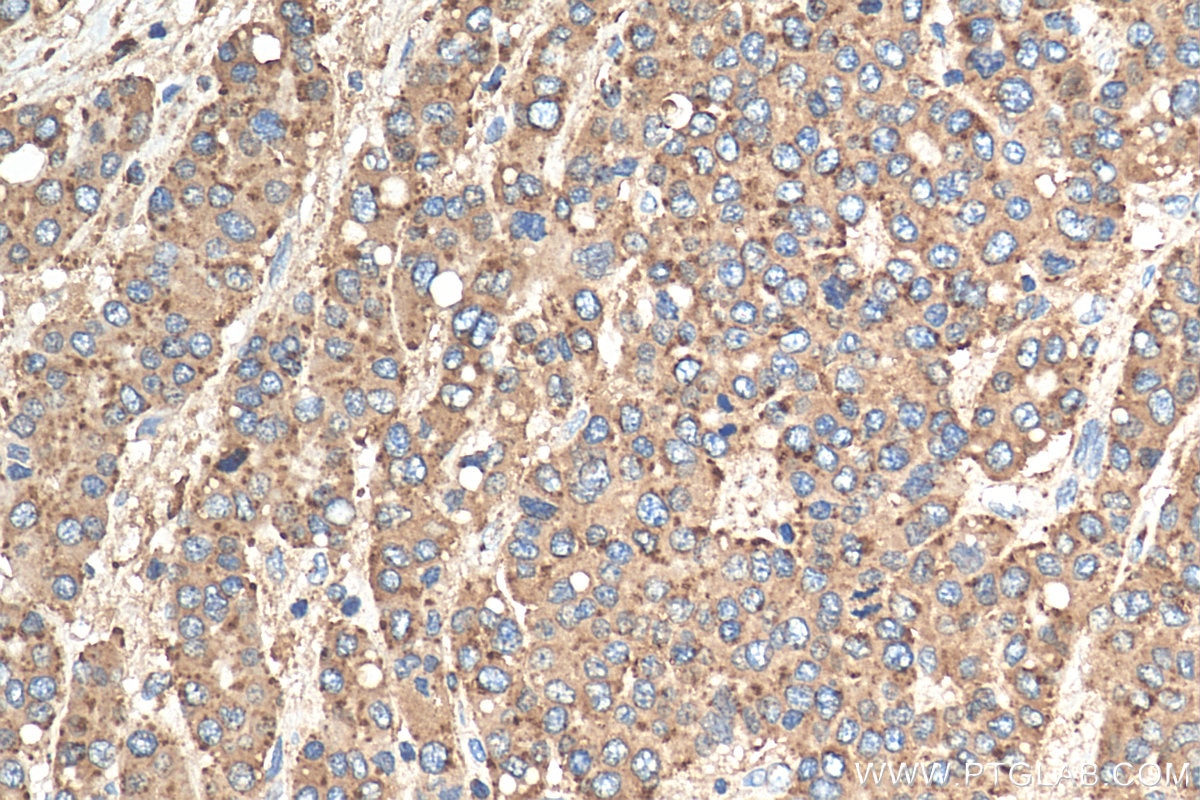 Immunohistochemistry (IHC) staining of human liver cancer tissue using CD107a / LAMP1 Polyclonal antibody (21997-1-AP)